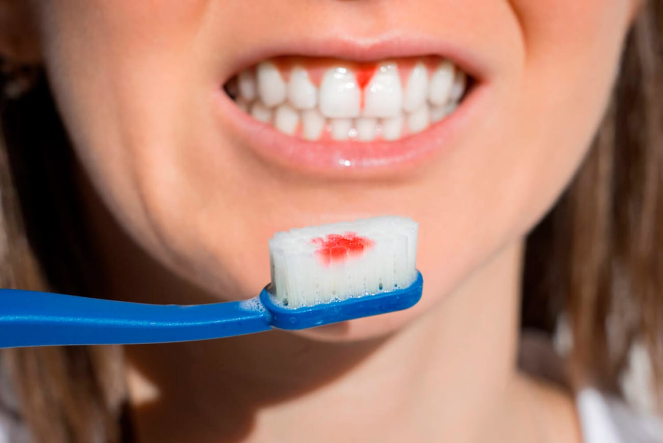 gingivitis hemorrágica